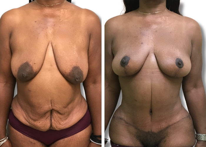 Abdominoplasty:Breast List Patient 1 4