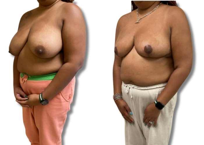 Patient 4_ 3 months post op bilateral breast reduction (2)