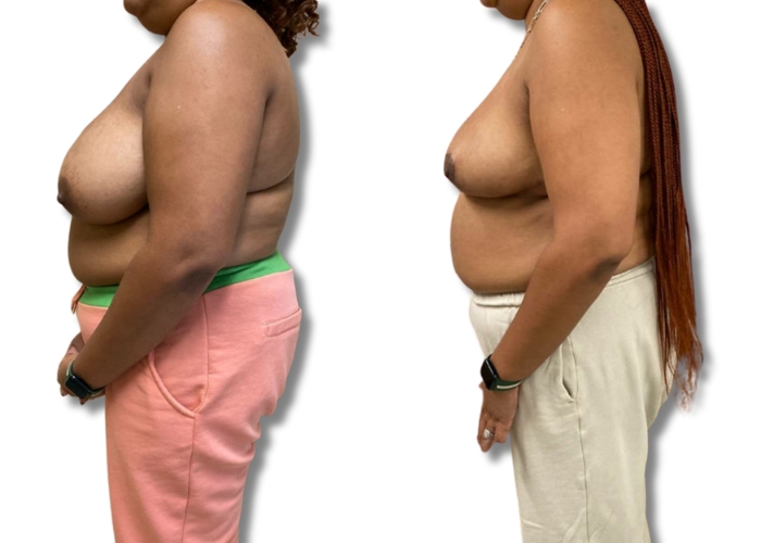 Patient 4_ 3 months post op bilateral breast reduction (3)