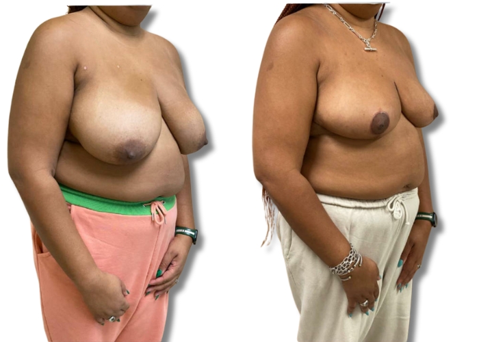 Patient 4_ 3 months post op bilateral breast reduction (4)