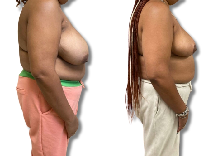 Patient 4_ 3 months post op bilateral breast reduction (5)