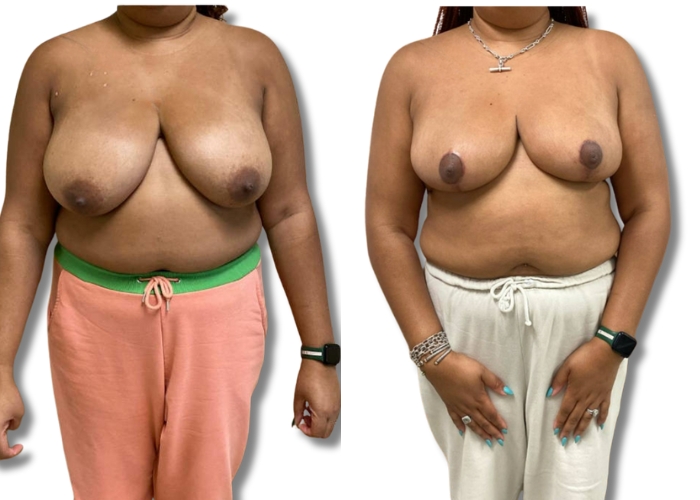 Patient 4_ 3 months post op bilateral breast reduction