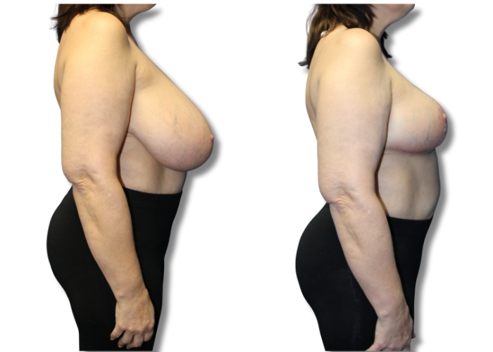 Patient 8 breast reduction 1