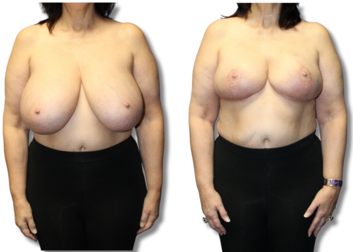 Patient 8 breast reduction 2