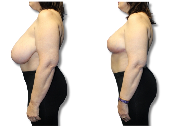 Patient 8 breast reduction 3