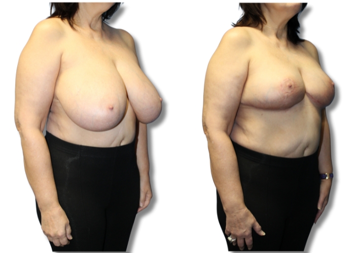 Patient 8 breast reduction 5