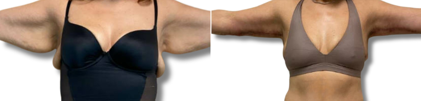 patient 6 brachioplasty index