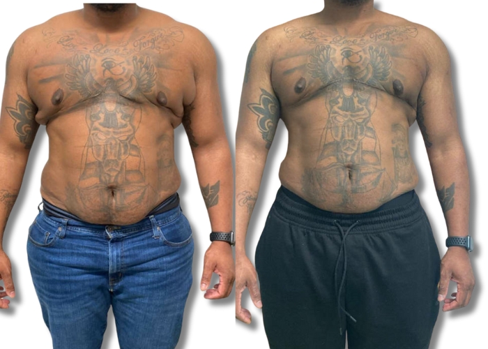 patient 7 one month top surgery revision 1