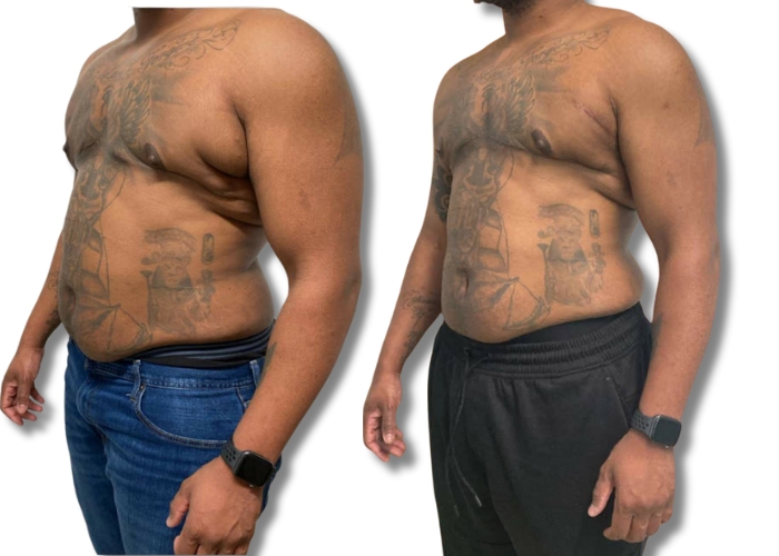 patient 7 one month top surgery revision 2