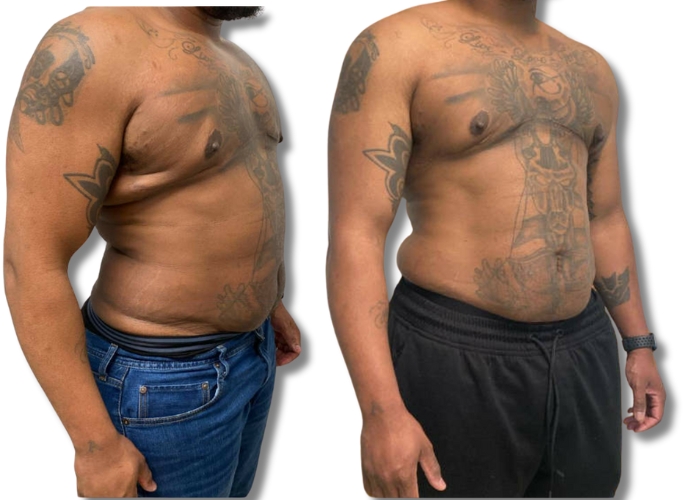 patient 7 one month top surgery revision 3