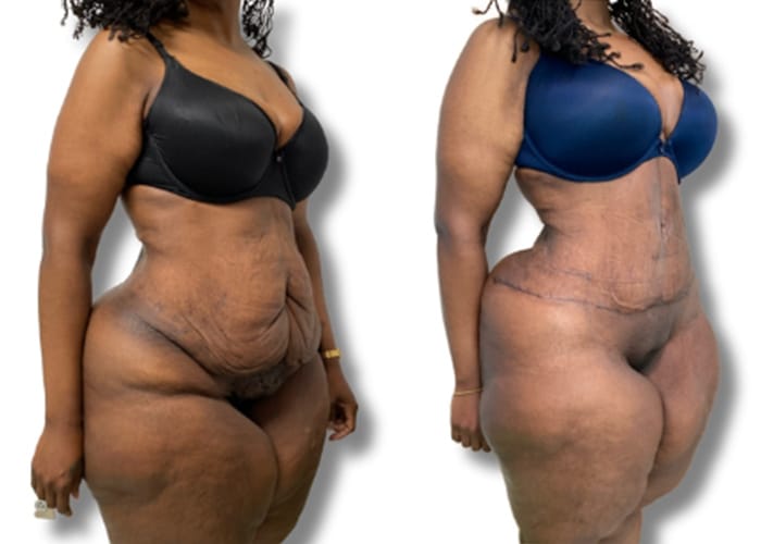 Abdominoplasty1