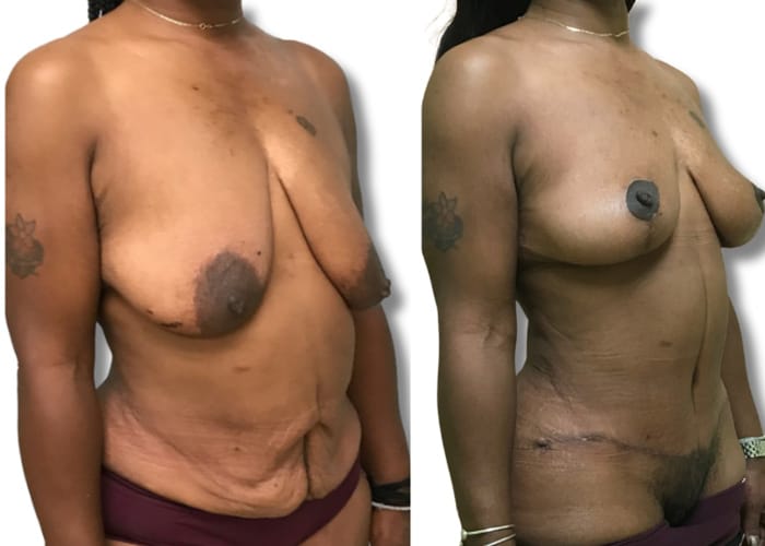 Abdominoplasty1
