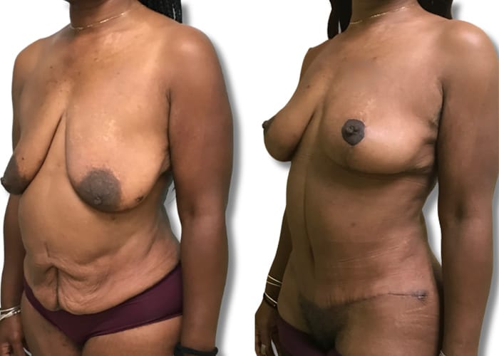 Abdominoplasty3