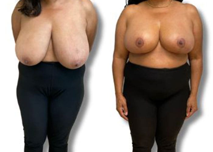 breast-reduction-7a