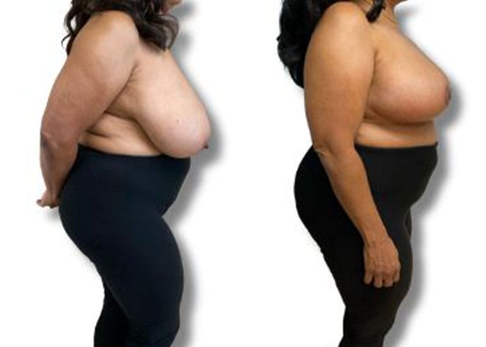 breast-reduction-7b