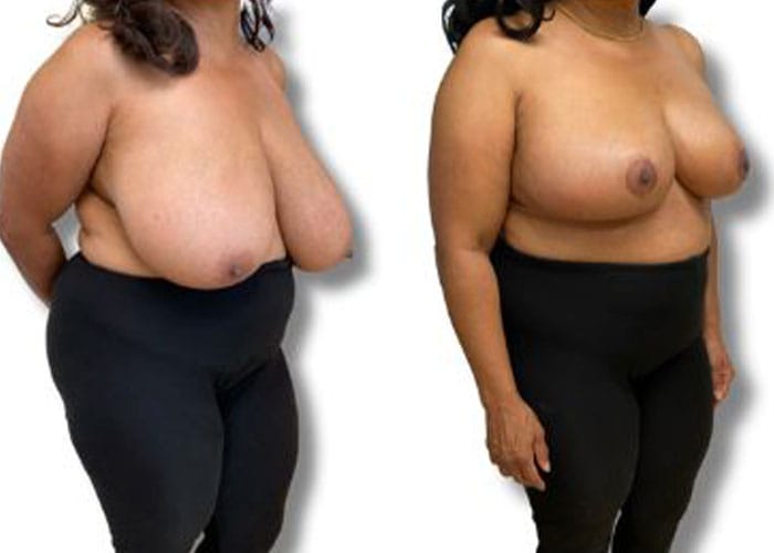 breast-reduction-7c