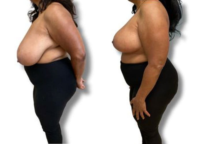 breast-reduction-7d