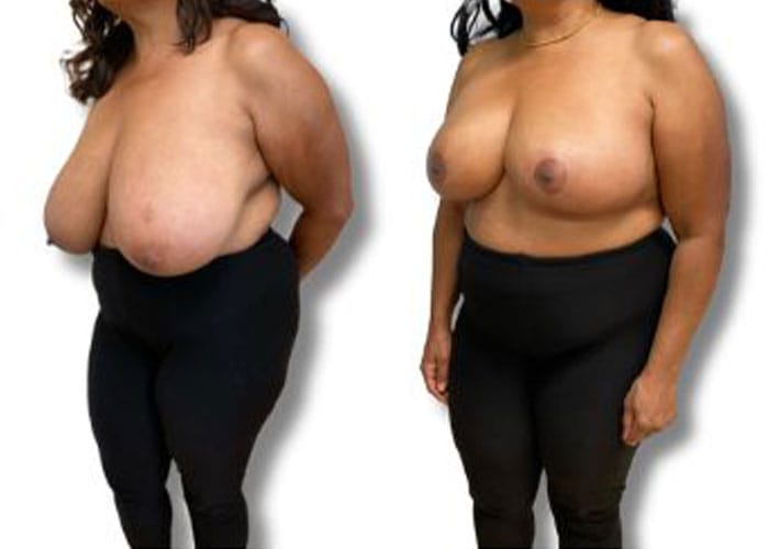 breast-reduction-7e