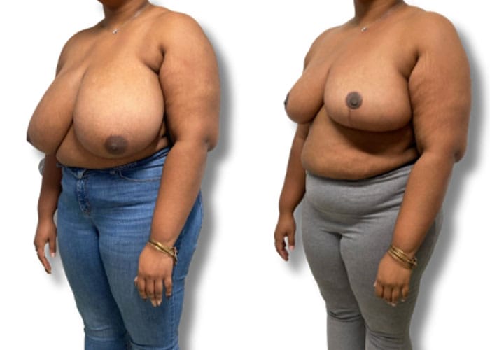 breast-reduction-8a