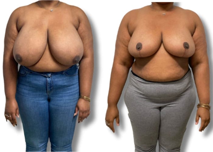 breast-reduction-8b