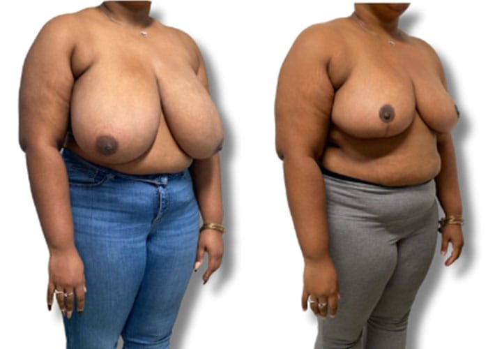 breast-reduction-8c