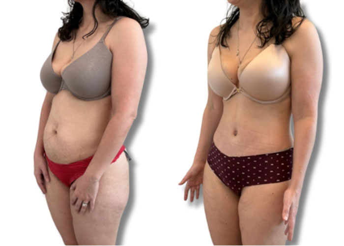 abdominoplasty-5c