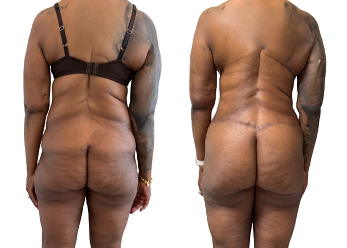 lower body surgery 1