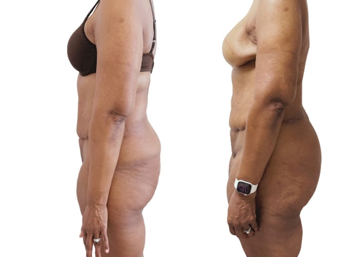 lower body surgery 3