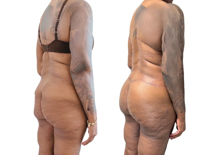 lower body surgery 4