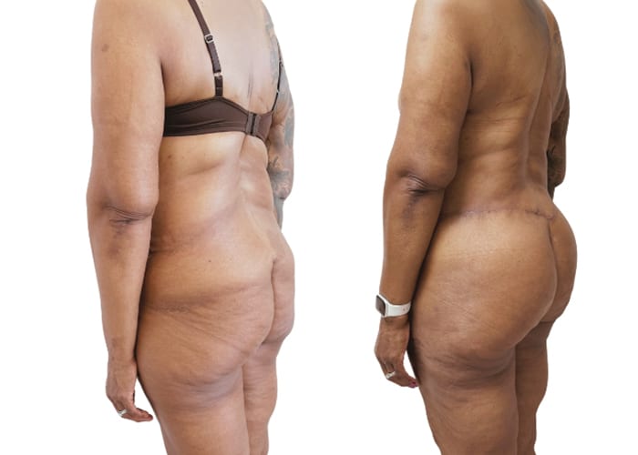 lower body surgery 5