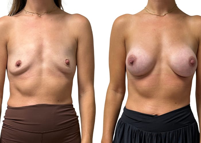 Breast aug 1