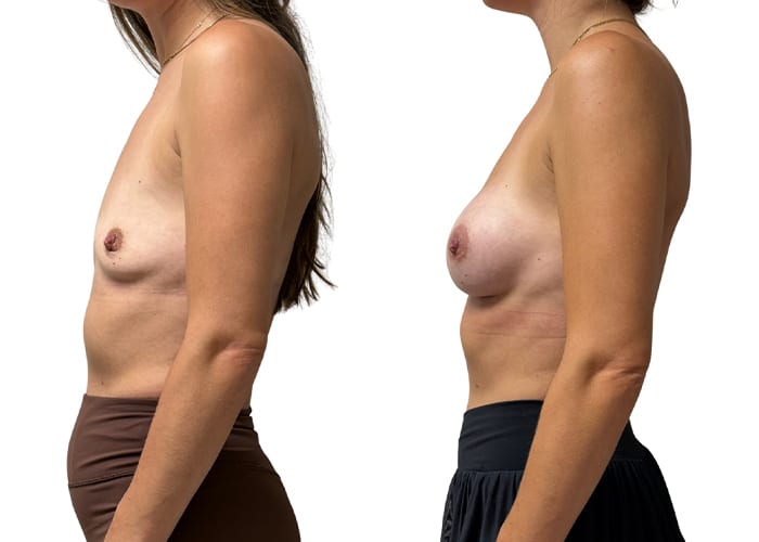 Breast aug 3