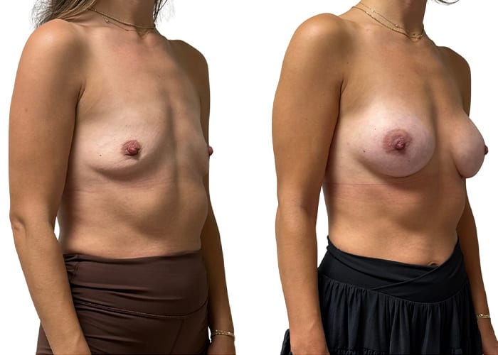 Breast aug 4