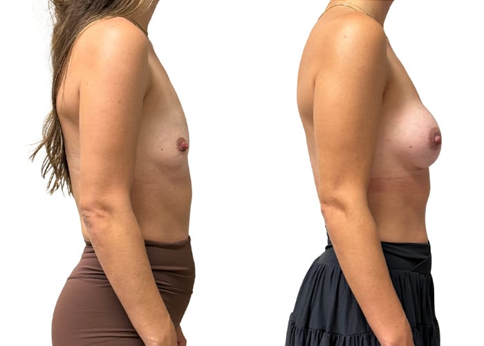 Breast aug 5