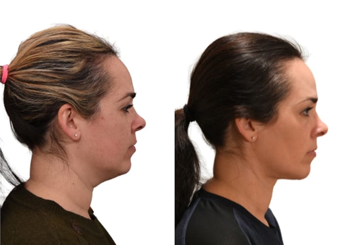 deep neck contouring
