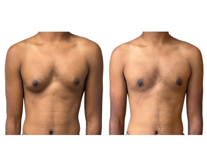 gynecomastia 1 - 1
