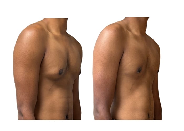 gynecomastia 1 - 2