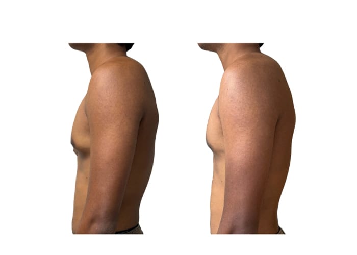 gynecomastia 1 - 3