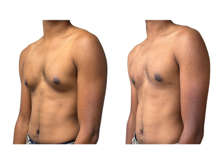 gynecomastia 1 - 4