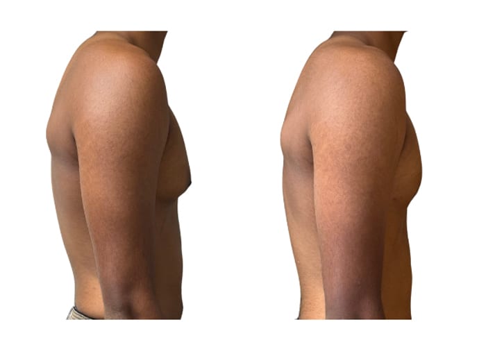 gynecomastia 1 - 5