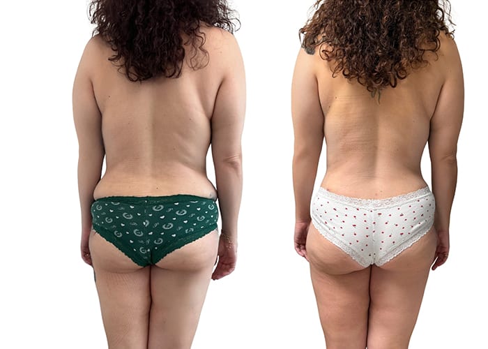lipoabdominoplasty-001