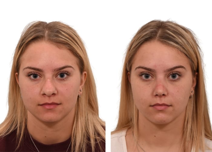 primary rhinoplasty with alar base reduction